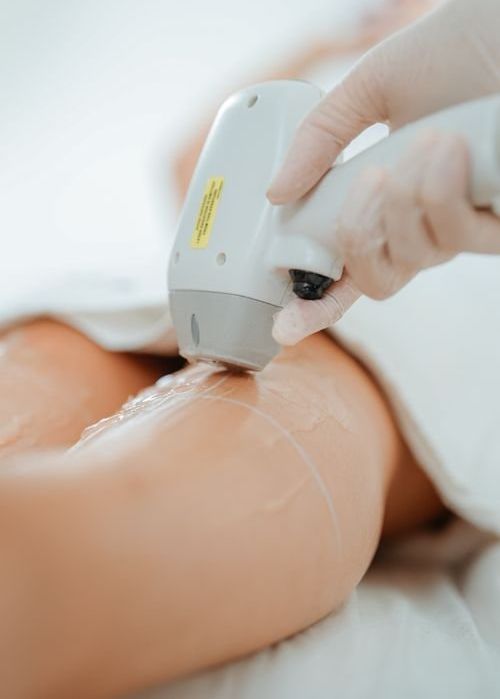 Depilação a laser Feroli Estética